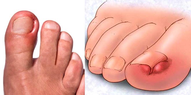 নখকুনি নিরাময়ের ঘরোয়া উপায়!