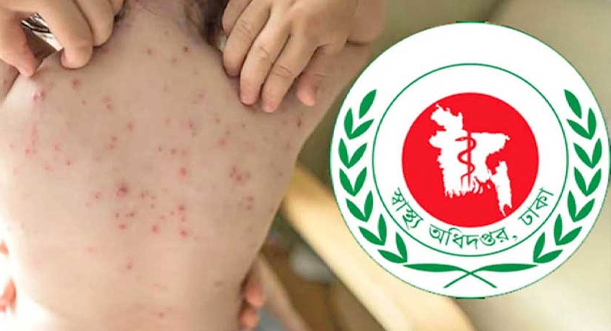 হাম ও উপসর্গ নিয়ে আরও ১৭ শিশুর মৃত্যু, বাড়ছে উদ্বেগ
